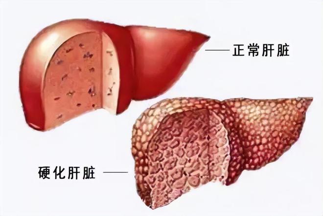 boyu体育全站app入口肝硬化乙肝患者千万别熬夜(图2)